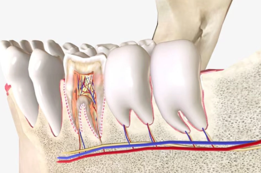 root canal recovery tips
