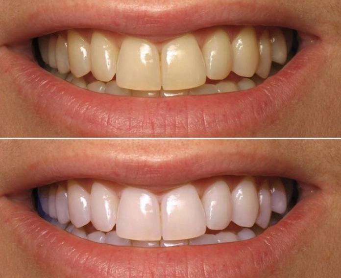 teeth whitening strips effectiveness