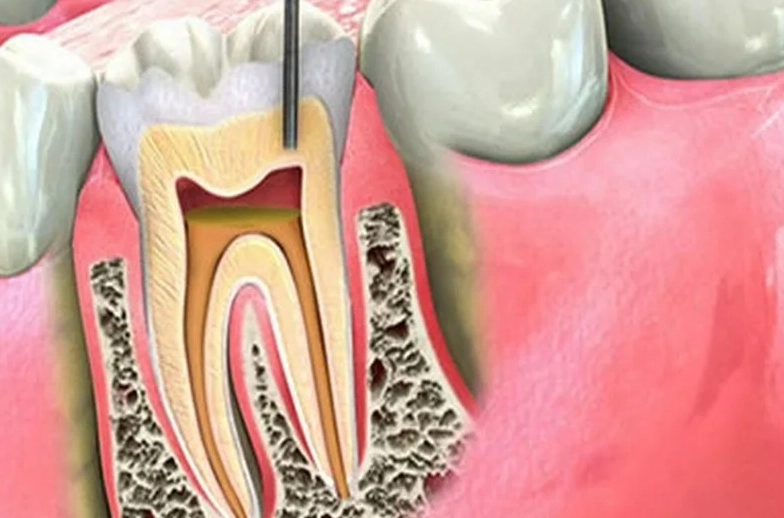 root canal recovery time