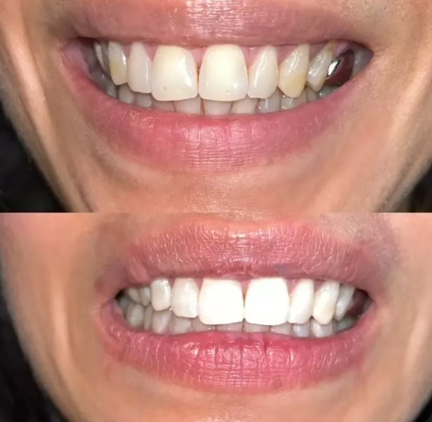 teeth whitening