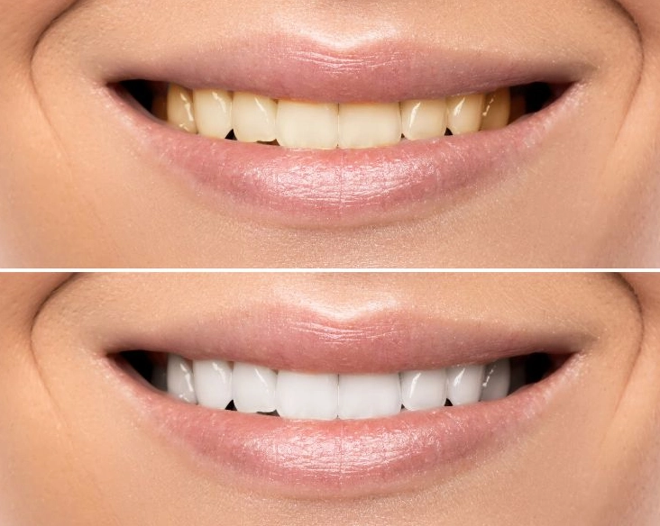 white teeth at home