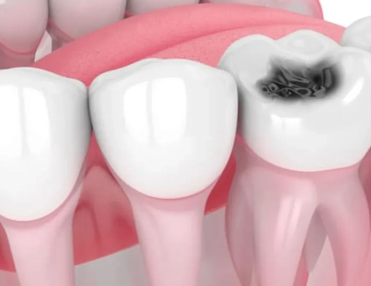 symptoms of root canal
