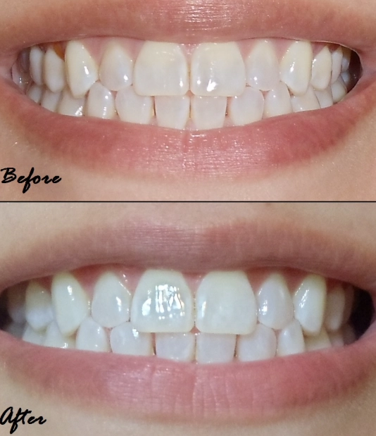 how long do crest whitening strips take to work
