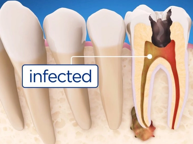 symptoms of root canal