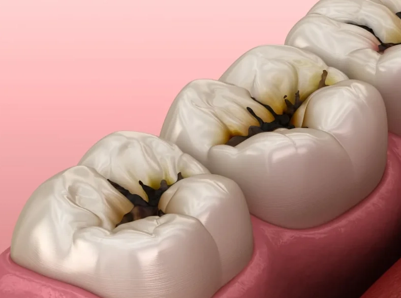 deep tooth decay