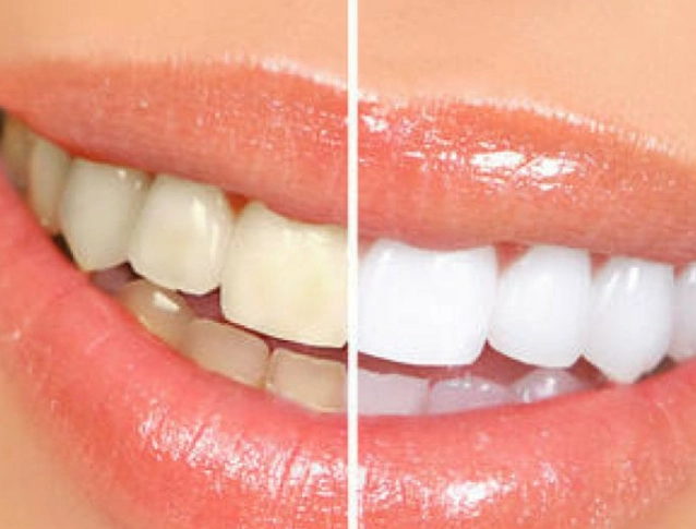 how to whiten teeth naturally