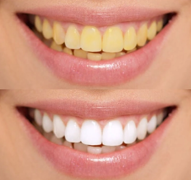 natural teeth whitening