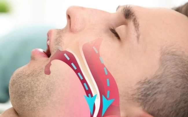 teeth grinding mouth guard