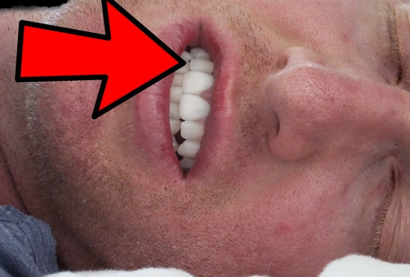 teeth grinding mouth guard