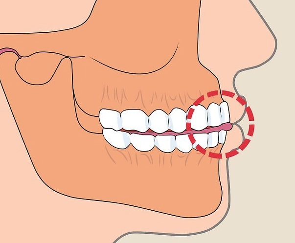 stop clenching teeth at night
