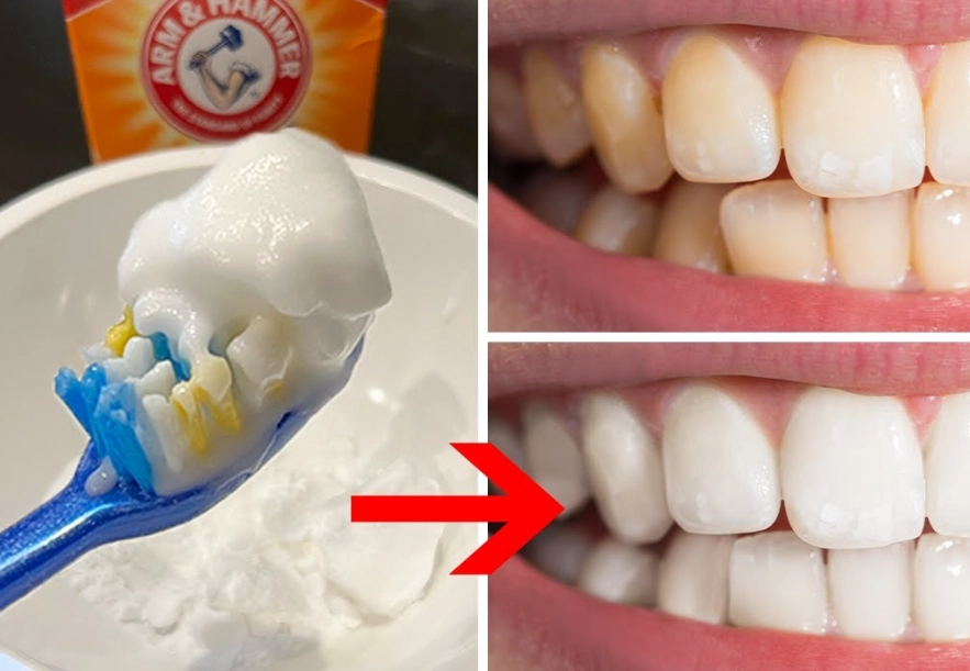 oil pulling for white teeth
