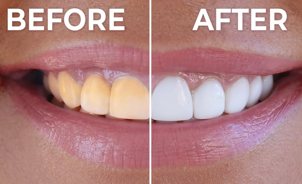 home teeth whitening without baking soda