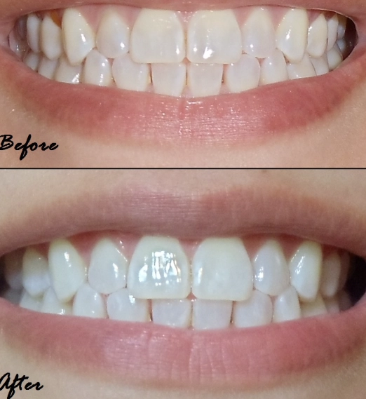 Do Crest white strips work immediately