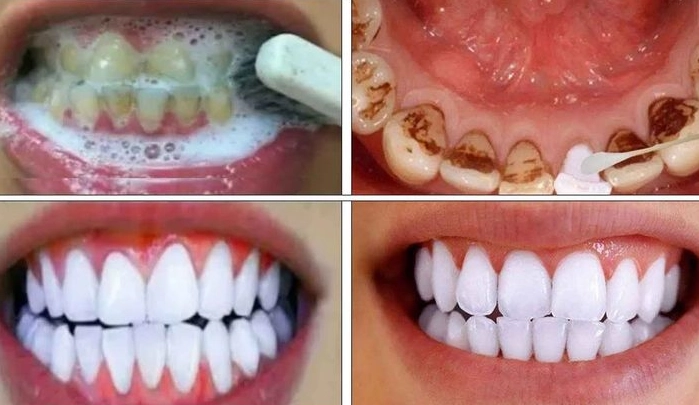 natural teeth whitening