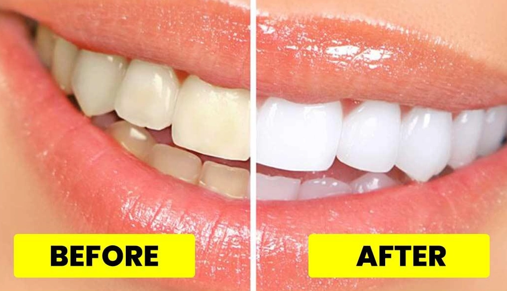 quick teeth whitening