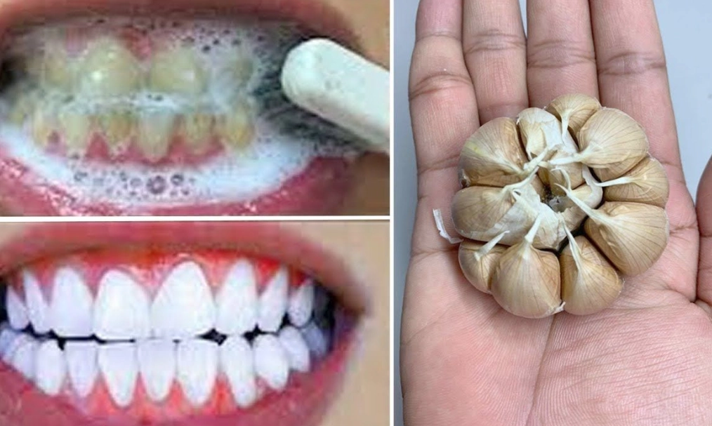 3 minute teeth whitening