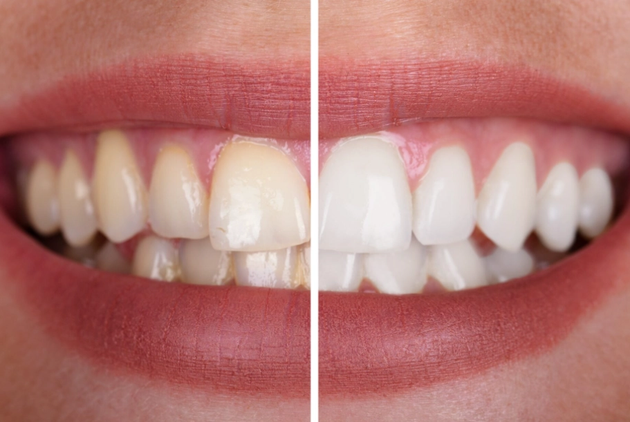 3 minute teeth whitening