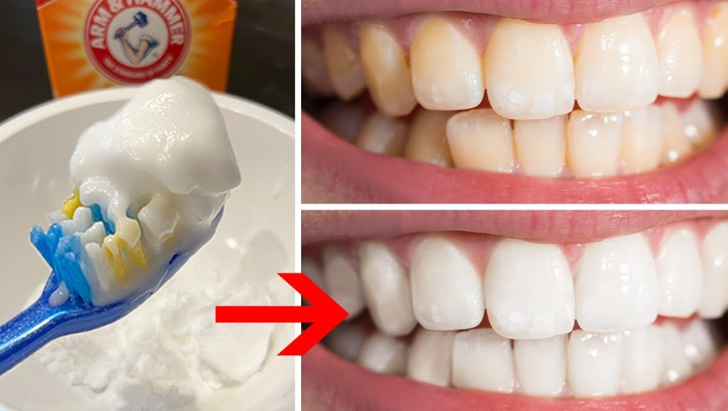teeth whitening fast