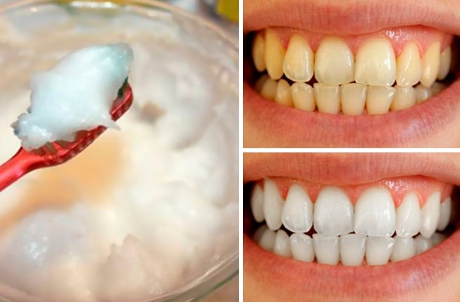 3 minute teeth whitening