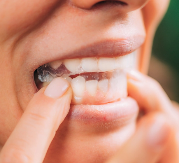 Do whitening strips damage teeth