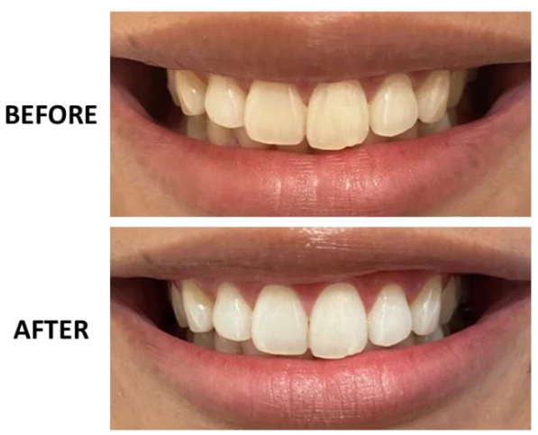 Do crest white strips work on teeth