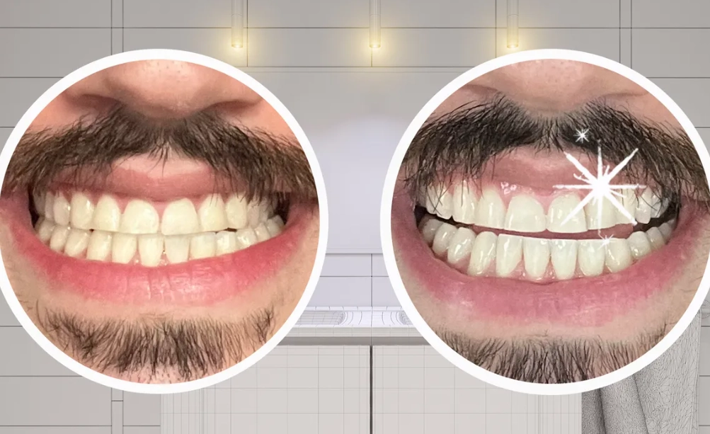 teeth whitening strips