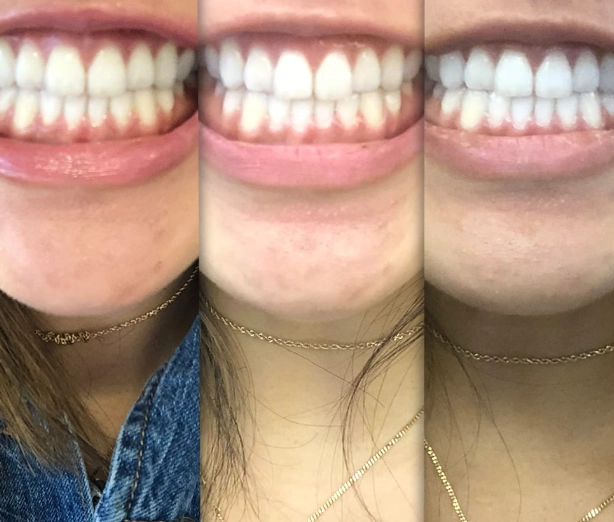 teeth whitening strips