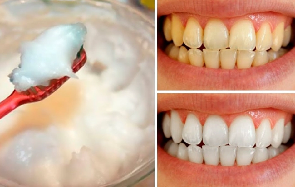 home remedies for white teeth