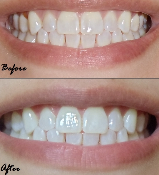 maintain white teeth after strips