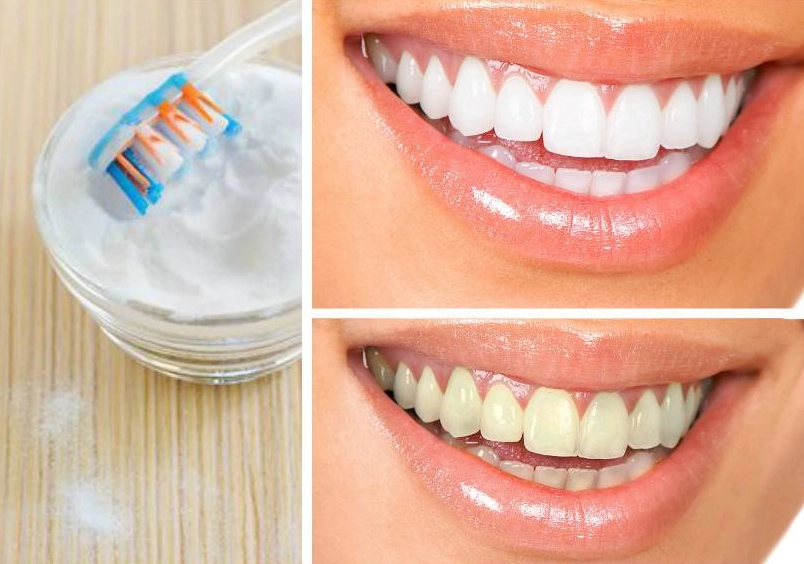 2 minute teeth whitening