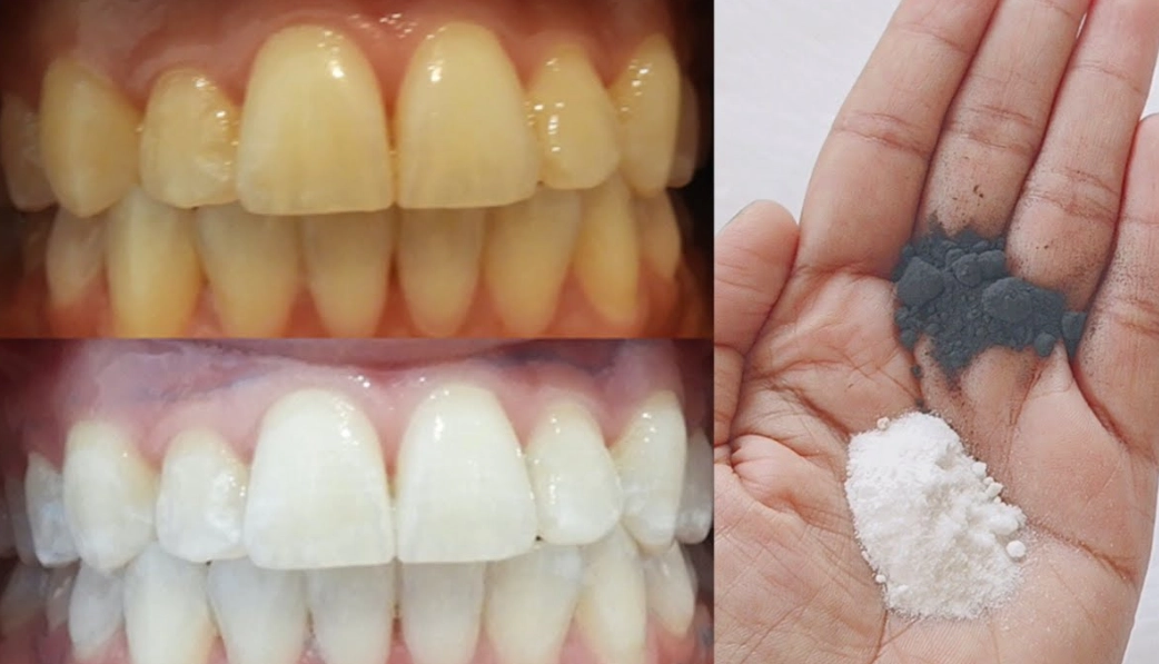 home teeth whitening kits
