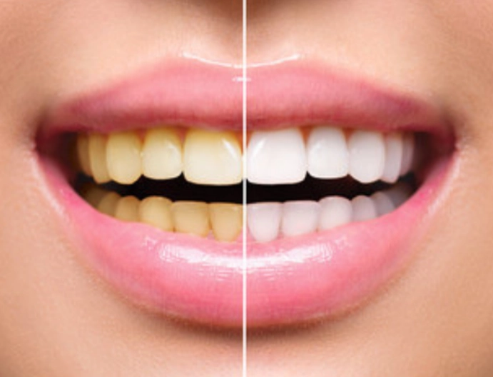 teeth whitening at home