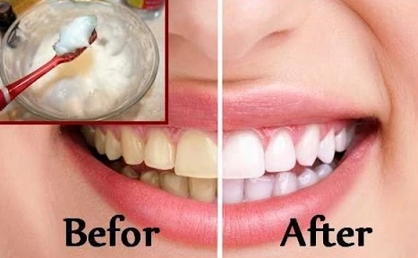 teeth whitening at home