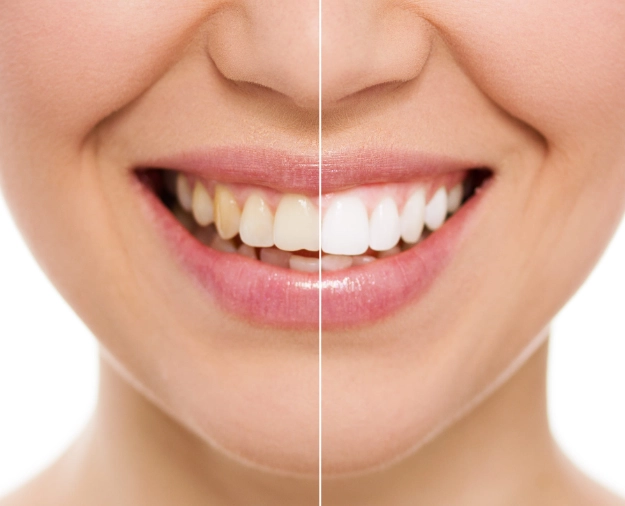 maintain white teeth after strips