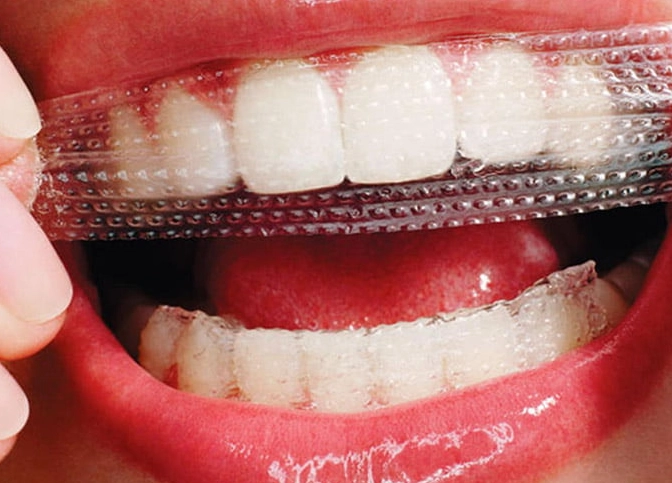 how long does teeth whitening last